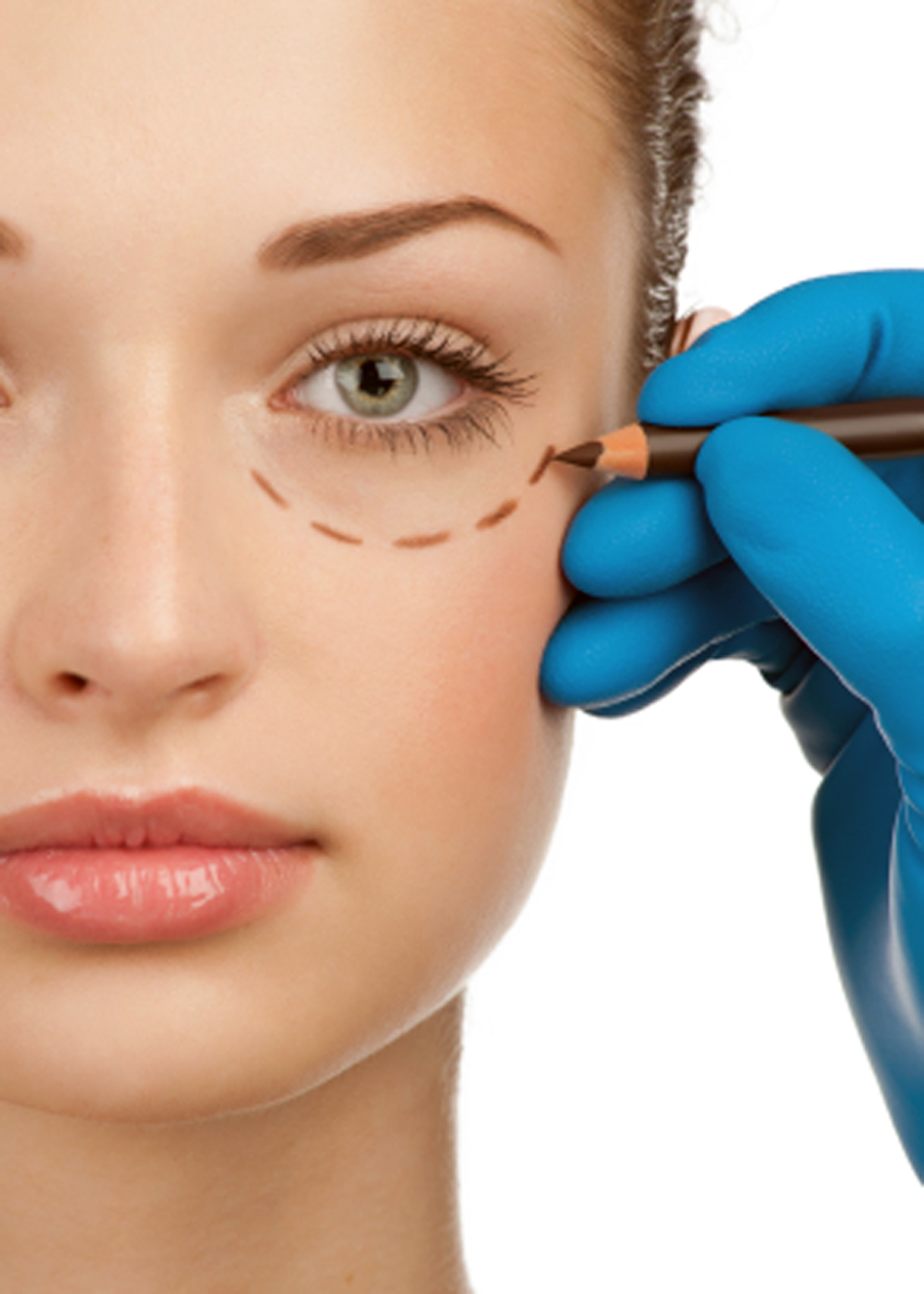 Блефаропластика трансконъюктивальная - это менее щадящий способ избавиться от жировой грыжи под нижним веком глаза. Благодаря разрезу по внутренней части века через слизистую оболочку становится возможным сократить время операции, возможность появления шрамов, а также послеоперационный период на реабилитацию.