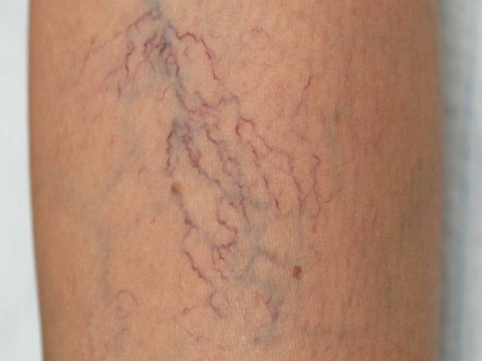 varikoznoe_rasshirenie_ven_nizhnih_konechnostey__2-e1452601913289