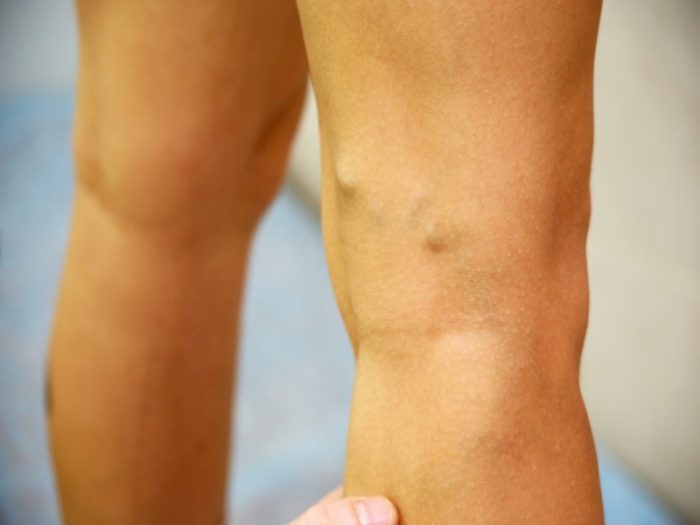 varikoznye-veny-03